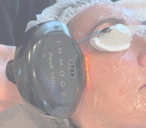 Lumecca Peak Treatment